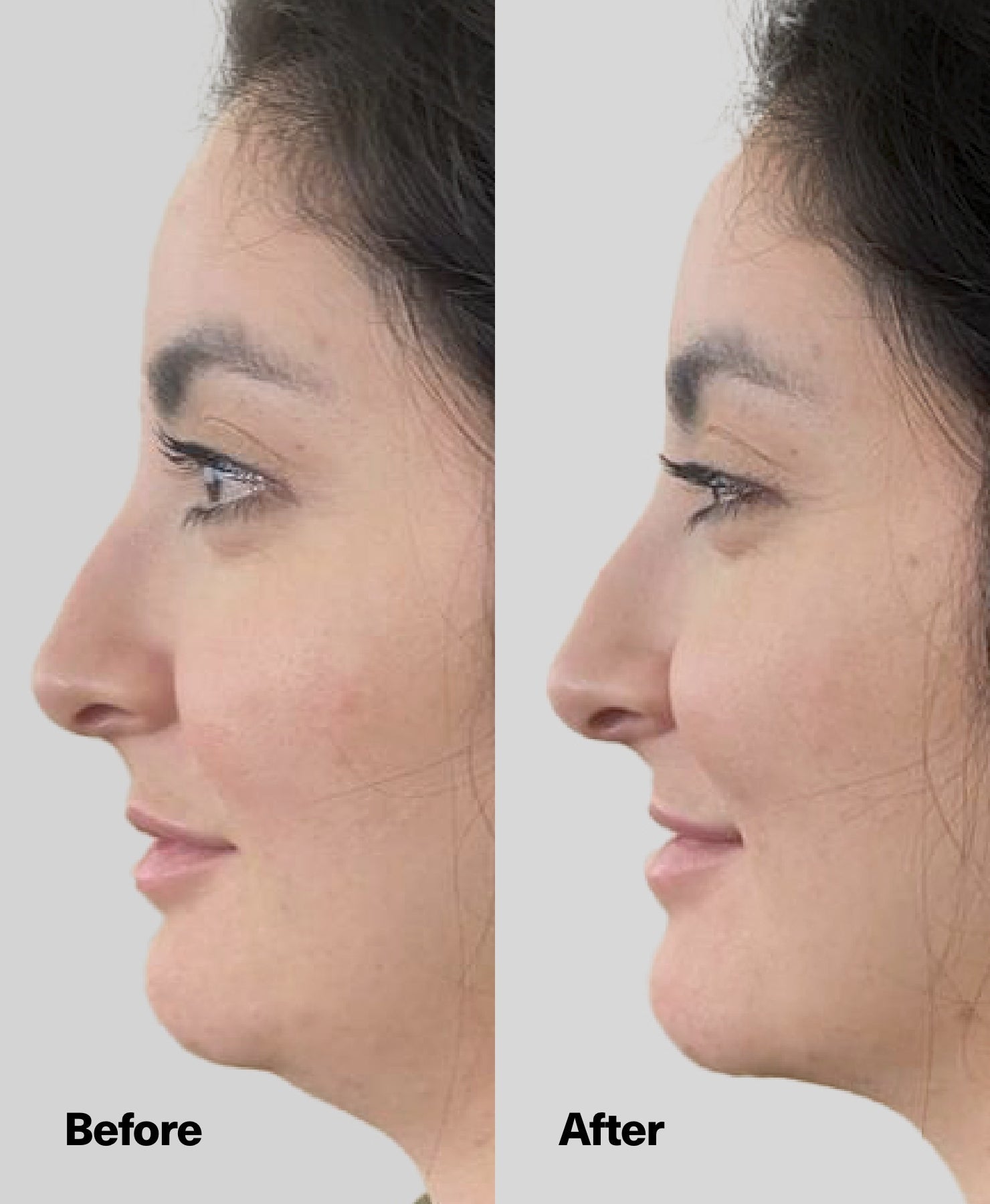 Caring for Your Jawline in Winter: Tips for a Defined Look in Dry Conditions