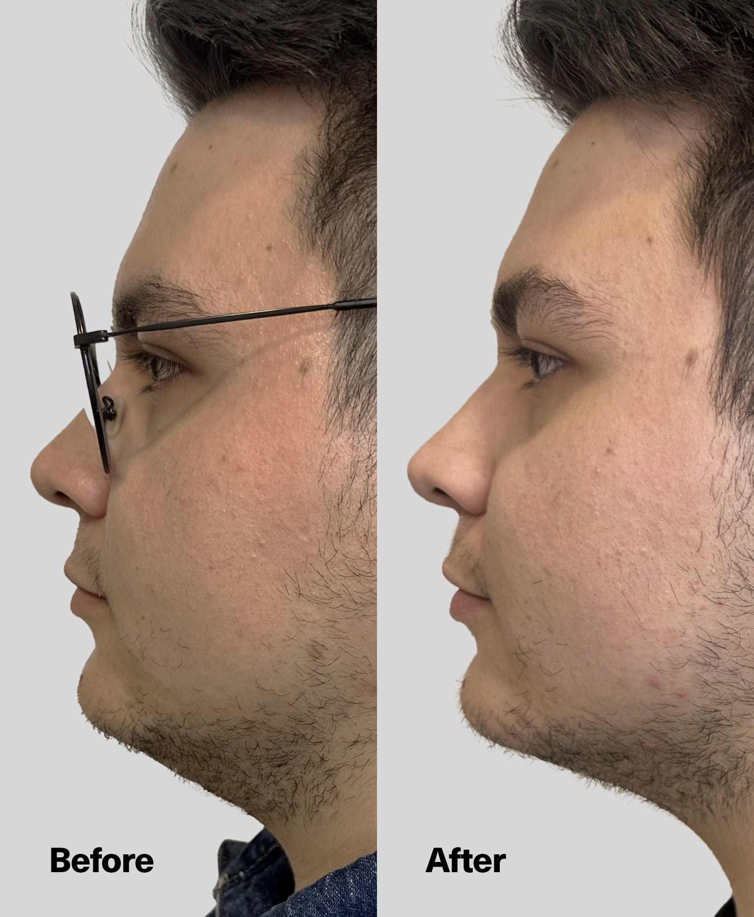 Male before and after jawline and neck results.