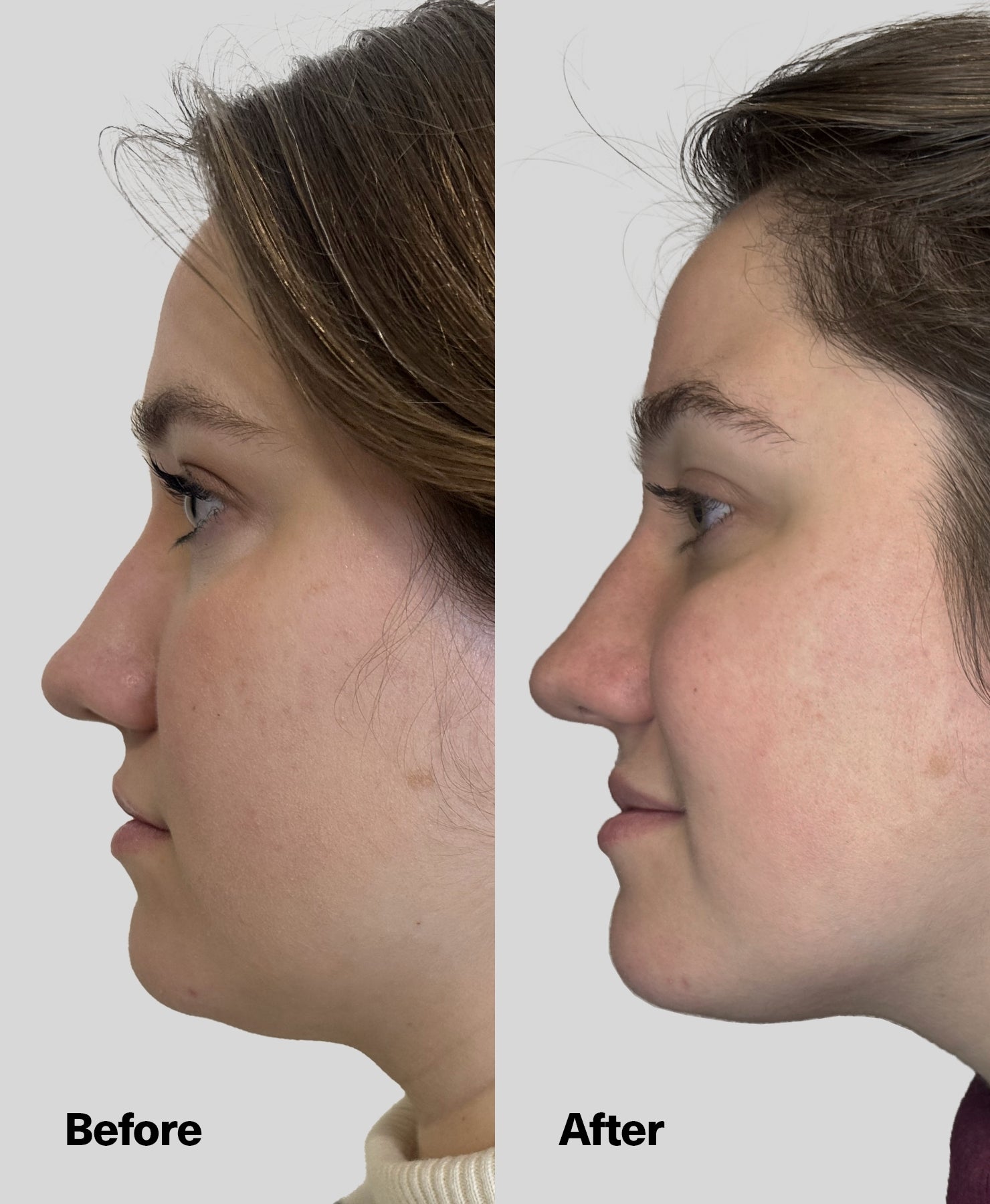 Female before and after jawline and neck results.