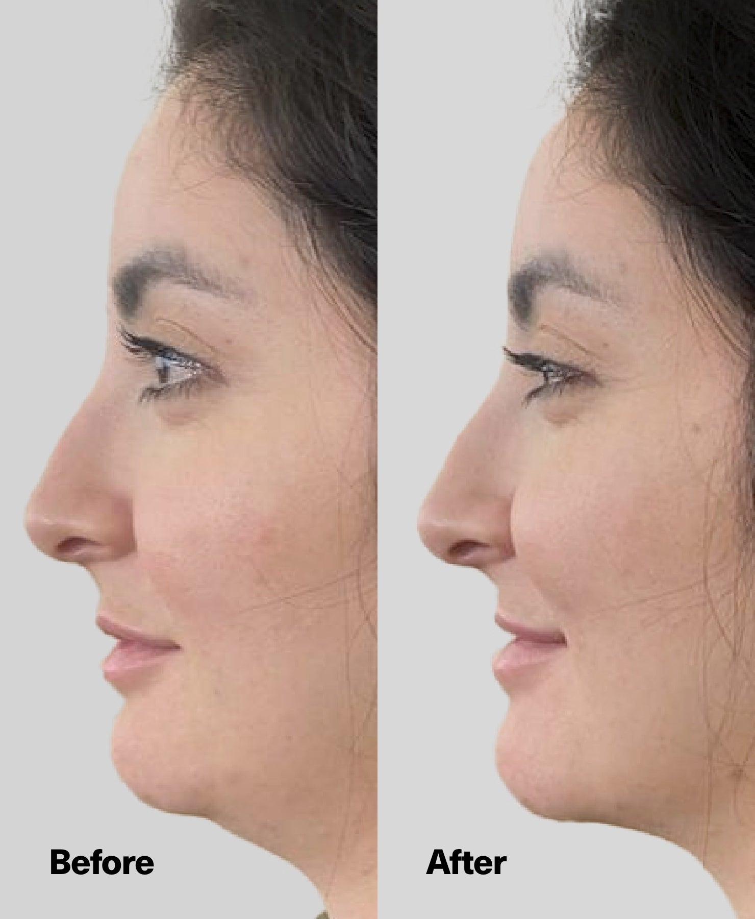 Female before and after jawline and neck results.