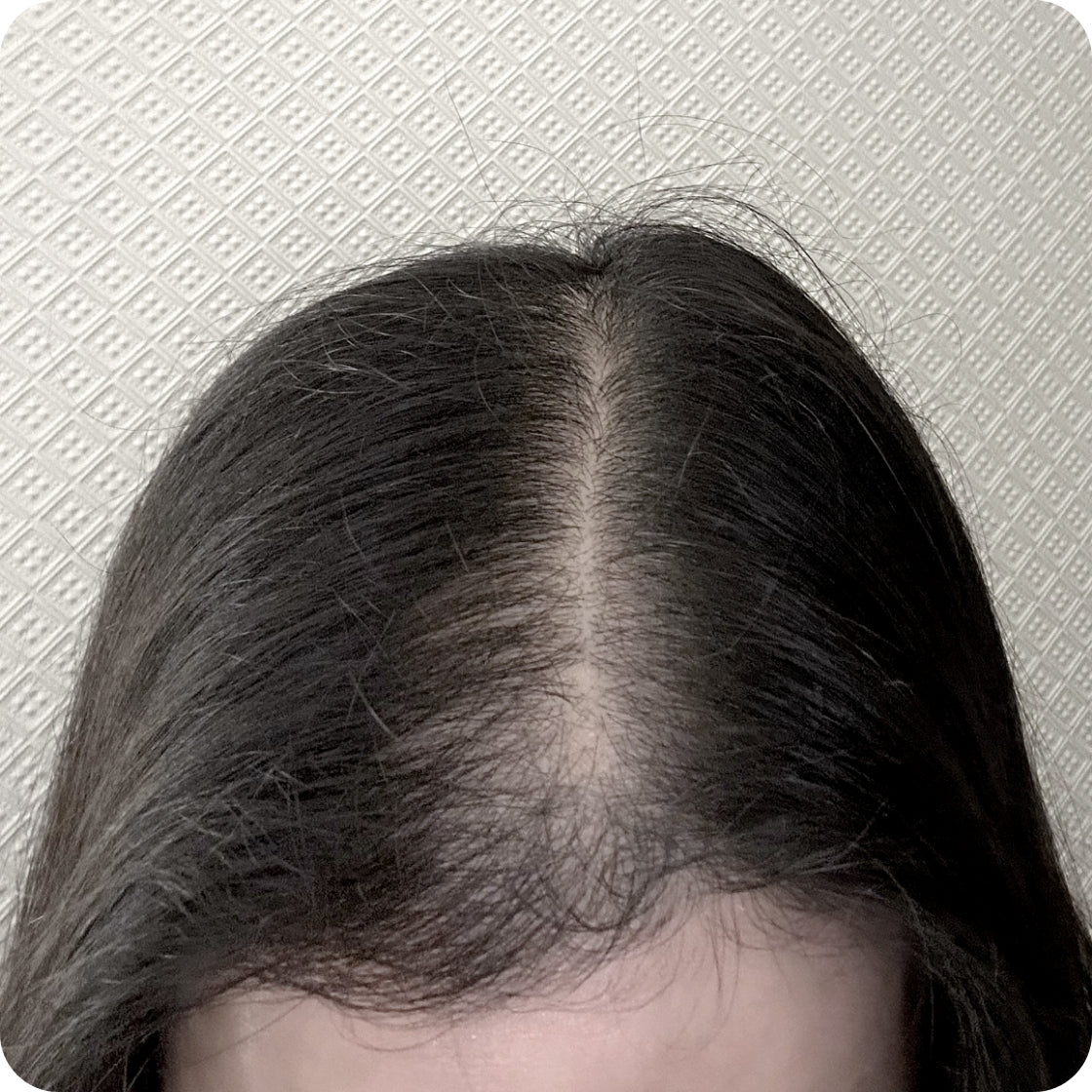 Hair growth afters. Exosomes hair loss.