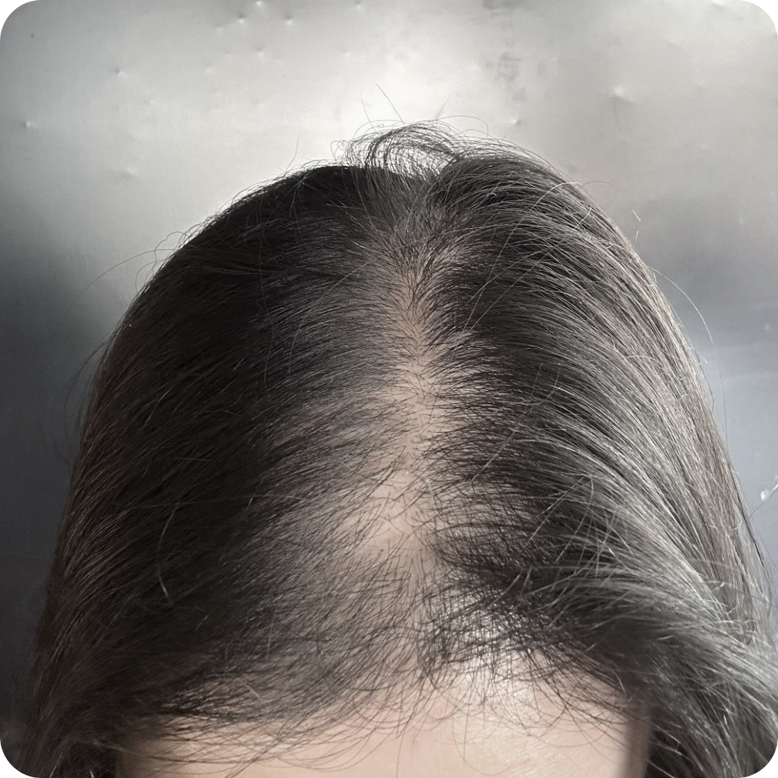 Hair growth before. Exosomes hair loss.