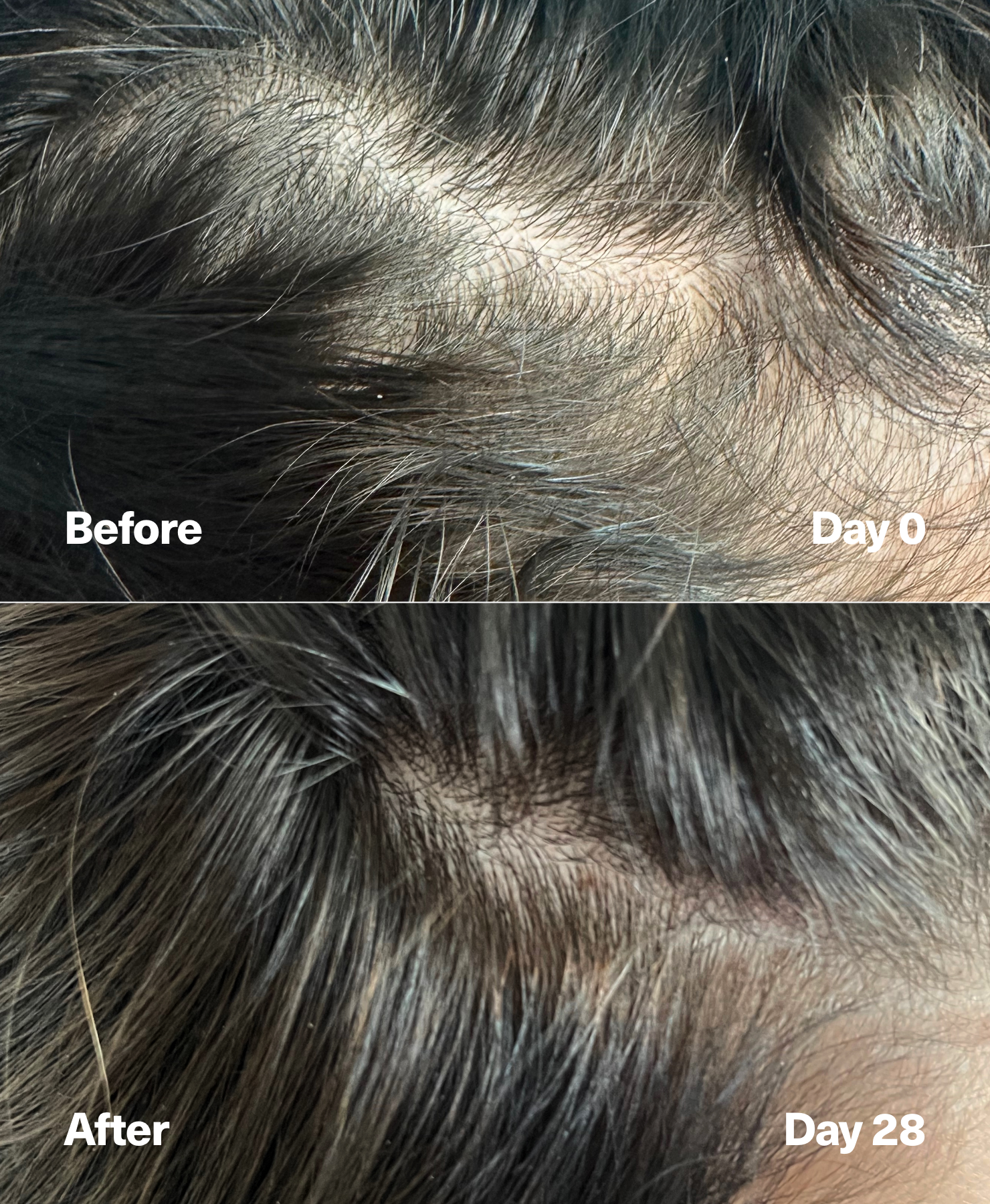 Hair growth before and afters. Exosomes hair loss.