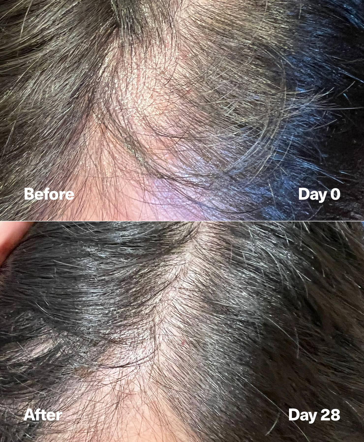 Hair growth before and afters. Exosomes hair loss.